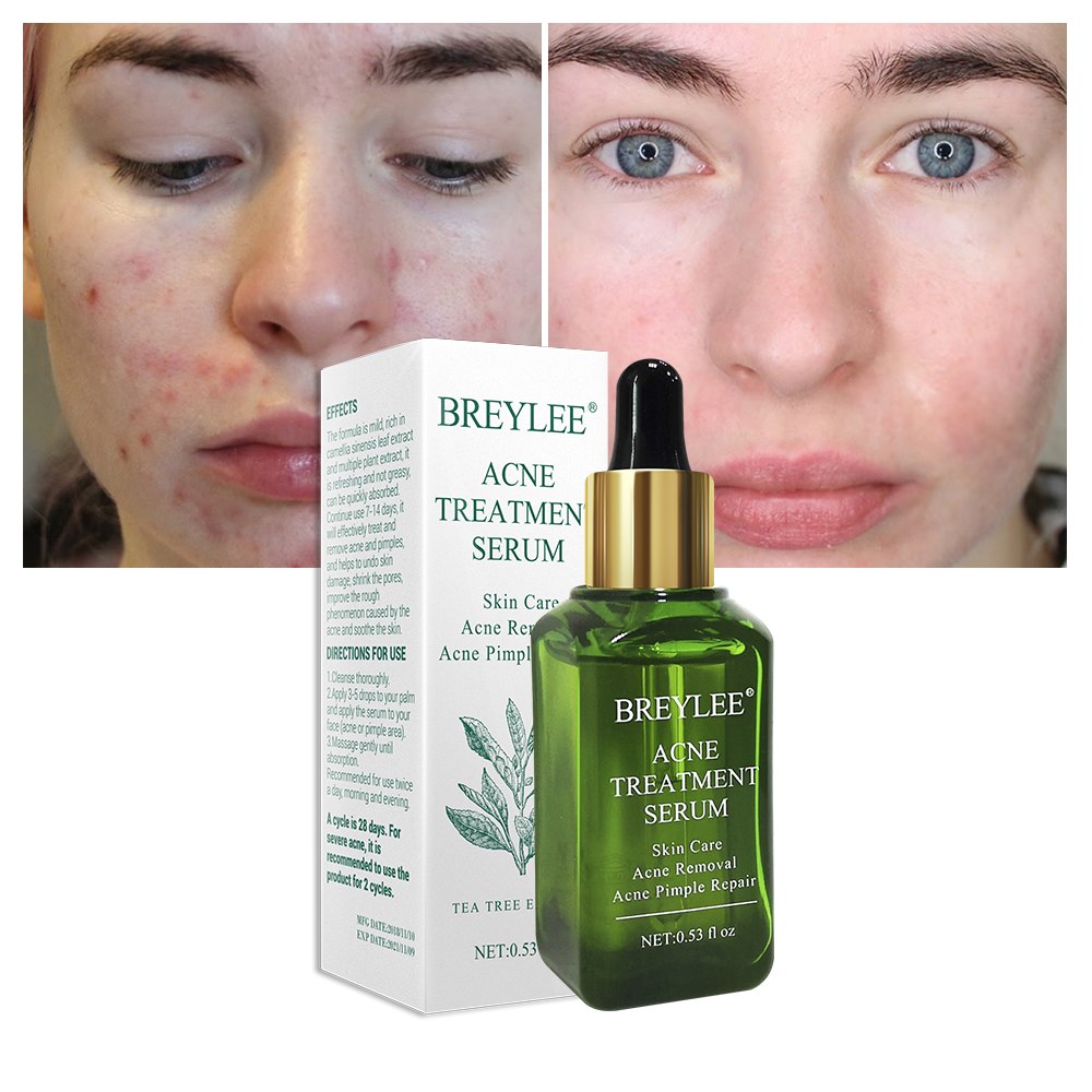 BREYLEE Acne Treatment Serum - Acne Scar Repair & Blemish Care