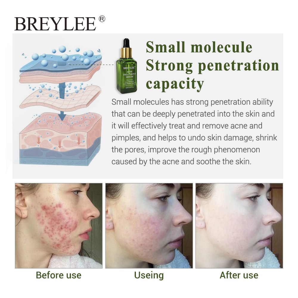 BREYLEE Acne Treatment Serum - Acne Scar Repair & Blemish Care