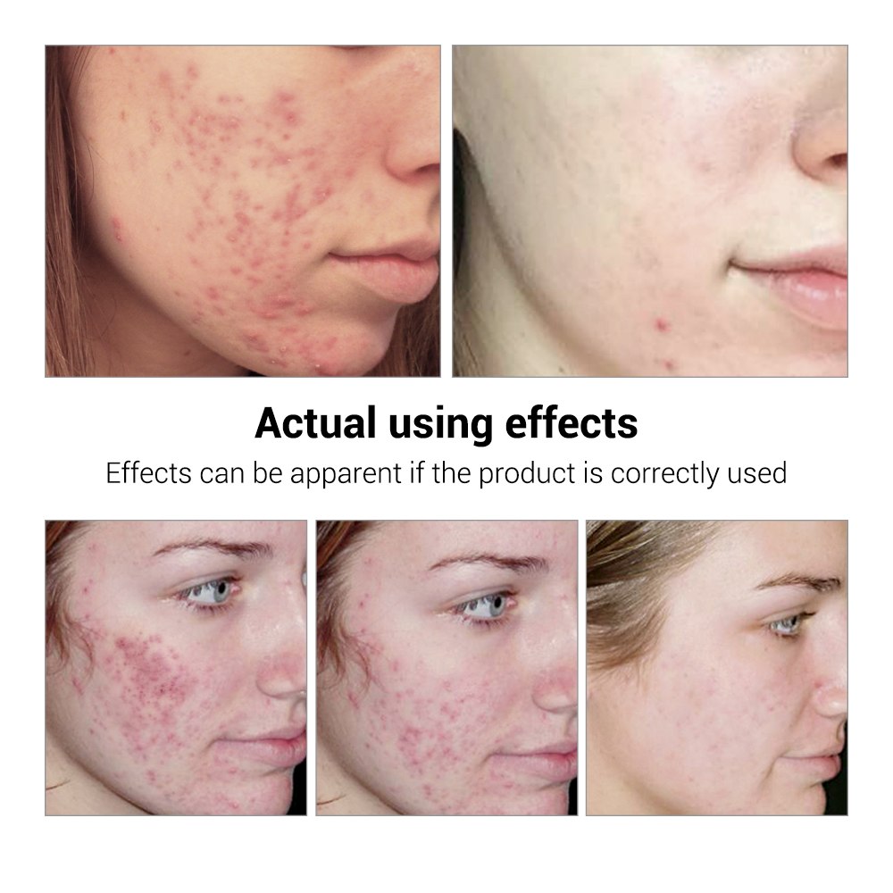 BREYLEE Acne Treatment Serum - Acne Scar Repair & Blemish Care