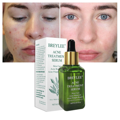 BREYLEE Acne Treatment Serum - Acne Scar Repair & Blemish Care